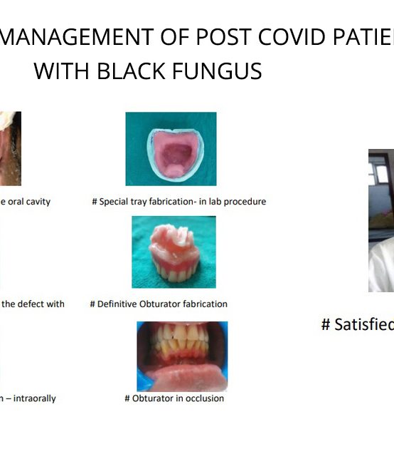 PROSTHETIC MANAGEMENT OF POST COVID PATIENTS WITH BLACK FUNGUS