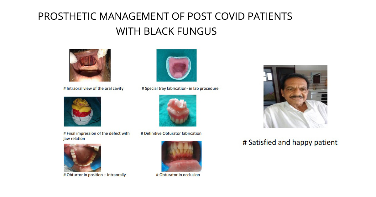 PROSTHETIC MANAGEMENT OF POST COVID PATIENTS WITH BLACK FUNGUS